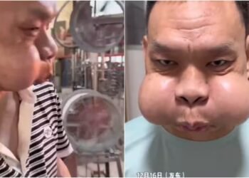 फ्रॉग प्रिंस’ के नाम से मशहूर हुआ कारीगर, 30 साल तक काम करने के बाद मेंढक की तरह हो गया चेहरा