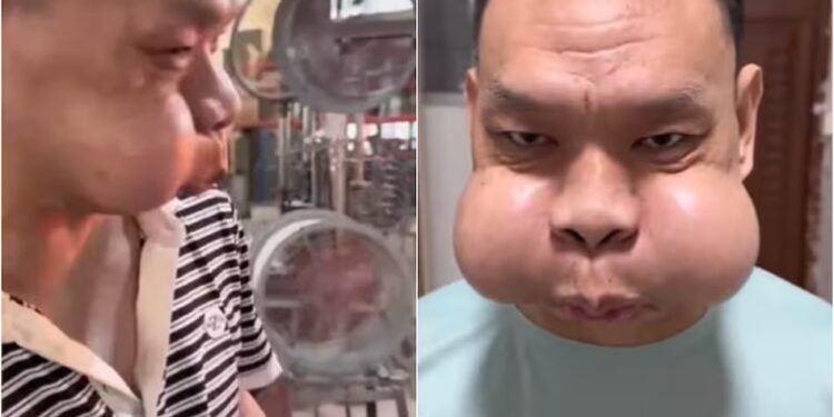 फ्रॉग प्रिंस’ के नाम से मशहूर हुआ कारीगर, 30 साल तक काम करने के बाद मेंढक की तरह हो गया चेहरा