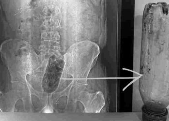 युवक ने प्राइवेट पार्ट में डाली बोतल, दर्द से तड़पा तो भागा अस्पताल, फिर..