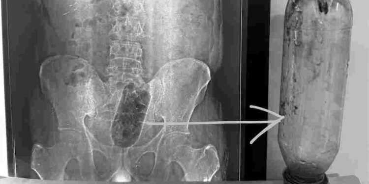 युवक ने प्राइवेट पार्ट में डाली बोतल, दर्द से तड़पा तो भागा अस्पताल, फिर..